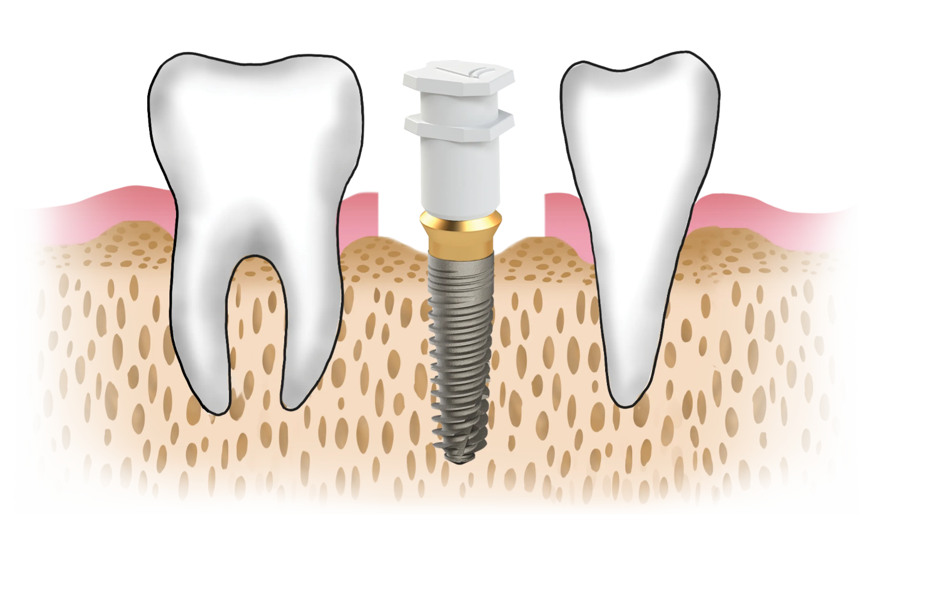 abutment_vidasi