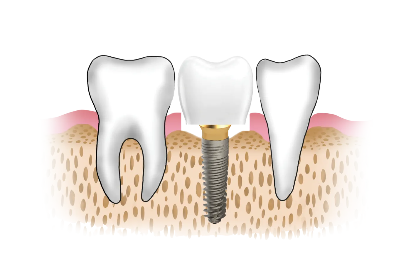 short-implant